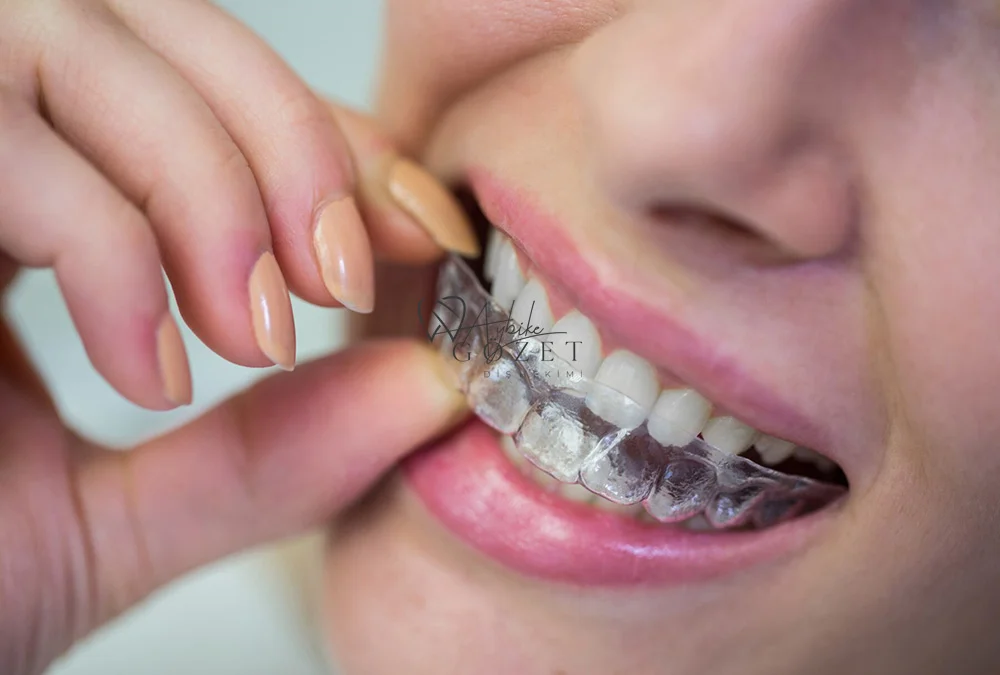 Şeffaf Plak - Invisalign