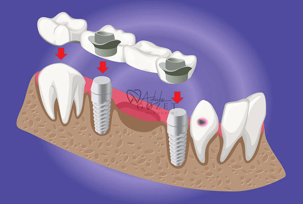 implant diş tedavisi