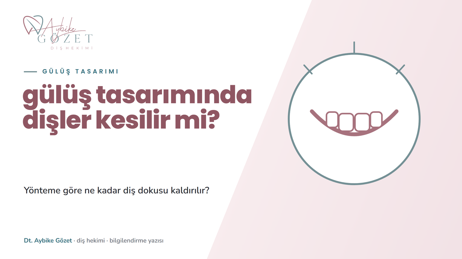 Gülüş tasarımında dişler kesilir mi: yönteme göre diş kesimi