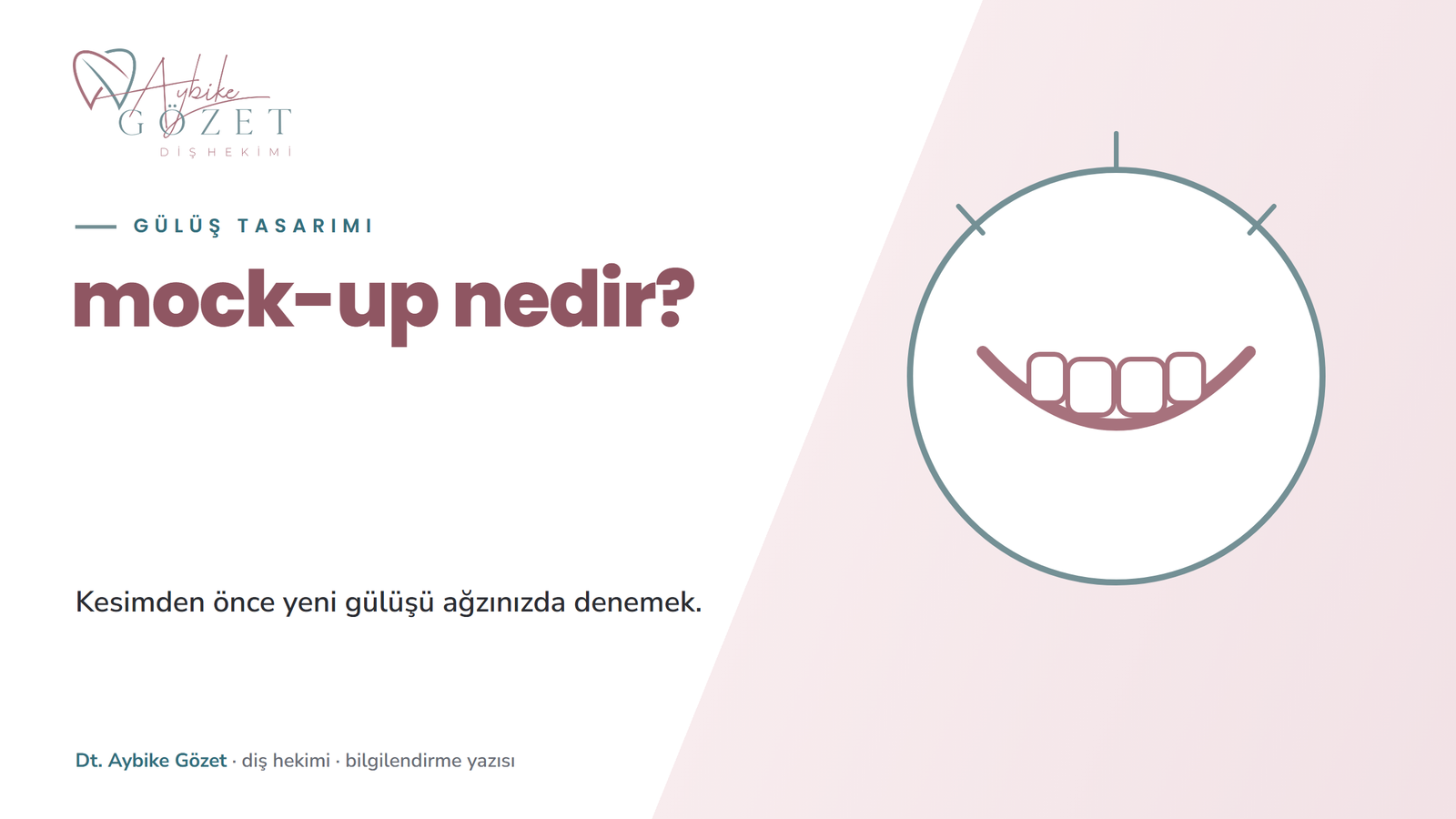 Mock-up nedir: gülüş tasarımında kesimden önce deneme