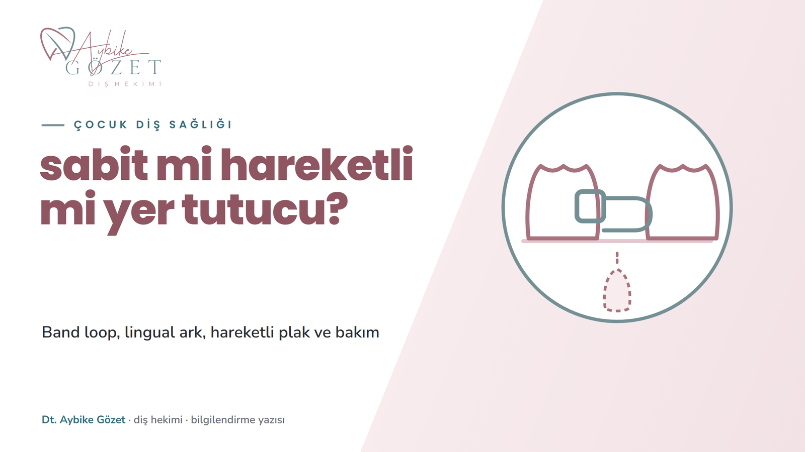 Sabit mi hareketli mi yer tutucu: band loop ve diğer seçenekler