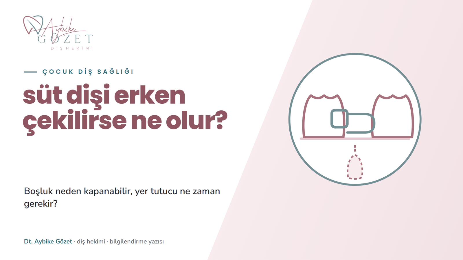 Süt dişi erken çekilirse ne olur: yer kaybı ve yer tutucu kararı